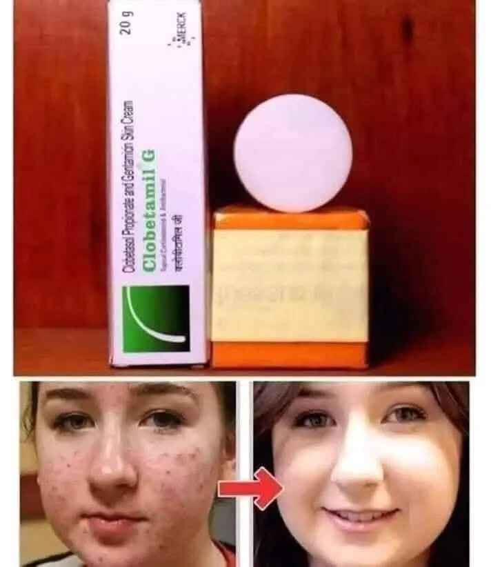 3-in-1 Combo Pack: Herbal Soap + Clobetamil G Cream + Round Night Cream